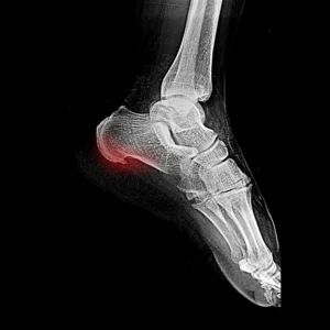Radiografia laterale del piede che mostra uno sperone calcaneare evidenziato in rosso alla base del tallone