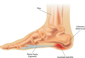 Disegno anatomico del piede visto di lato che mostra la fascia plantare infiammata (fascite plantare) con evidenza di tibia, calcagno e legamento plantare