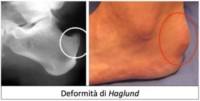 Immagine comparativa della sindrome di Haglund, con una radiografia laterale del piede che mostra una prominenza ossea posteriore sul calcagno e una foto clinica con evidenziata la deformità visibile a livello del tallone