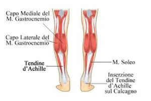 Illustrazione anatomica del tendine di Achille e dei muscoli coinvolti: capo mediale e laterale del gastrocnemio, muscolo soleo e inserzione del tendine di Achille sul calcagno