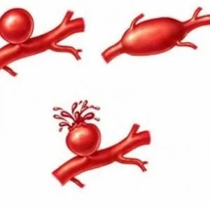 Illustrazione medica delle fasi dell’aneurisma cerebrale: dilatazione del vaso, espansione e rottura con emorragia