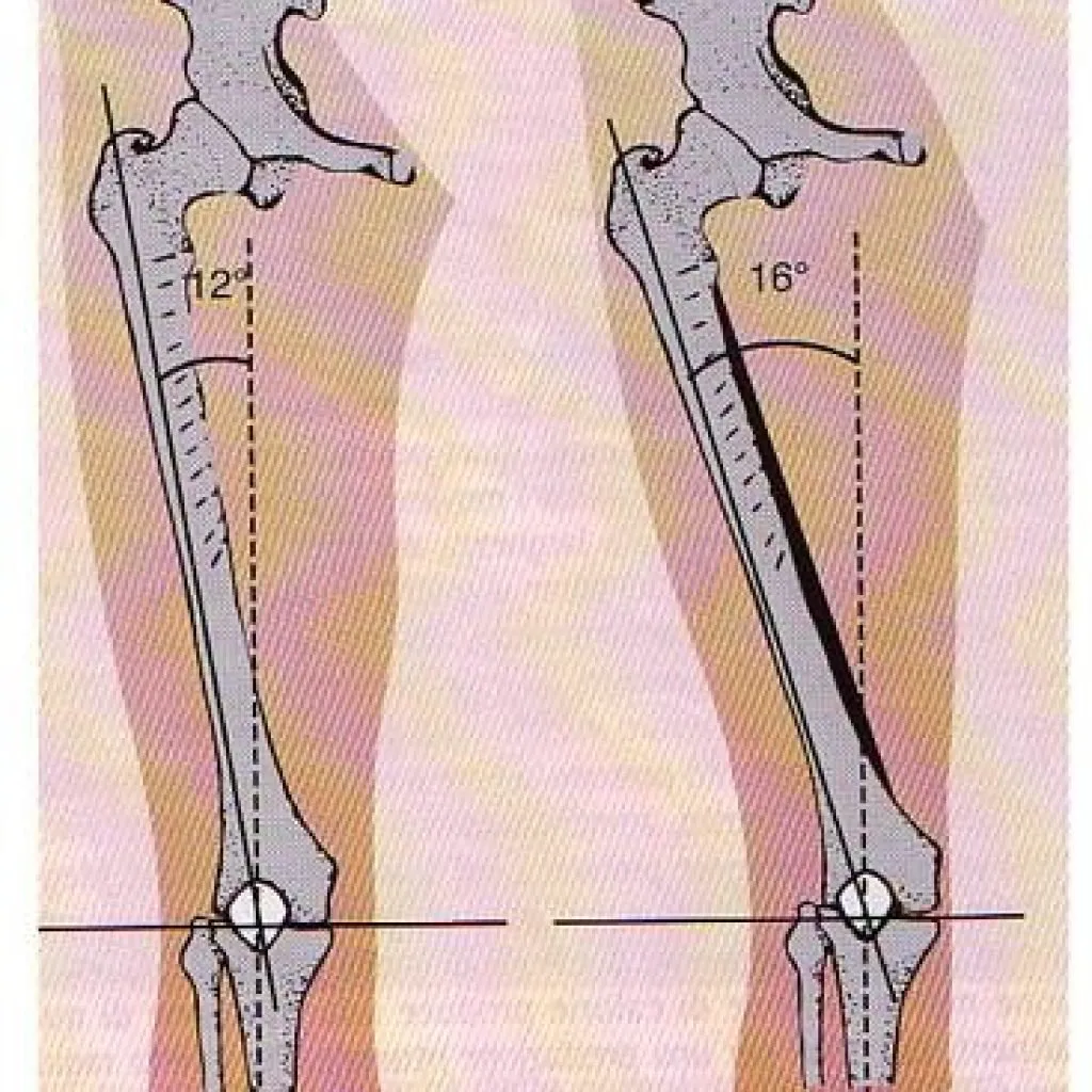 Illustrazione comparativa dell’angolo del femore rispetto alla tibia in due diverse condizioni anatomiche dell’arto inferiore