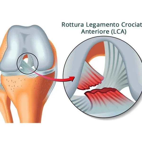 Illustrazione della rottura del legamento crociato anteriore (LCA) con ingrandimento del danno interno al ginocchio