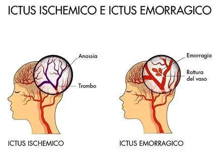 Illustrazione comparativa tra ictus ischemico e ictus emorragico: a sinistra, il blocco del flusso sanguigno nel cervello causato da un trombo; a destra, una rottura di un vaso cerebrale con emorragia interna