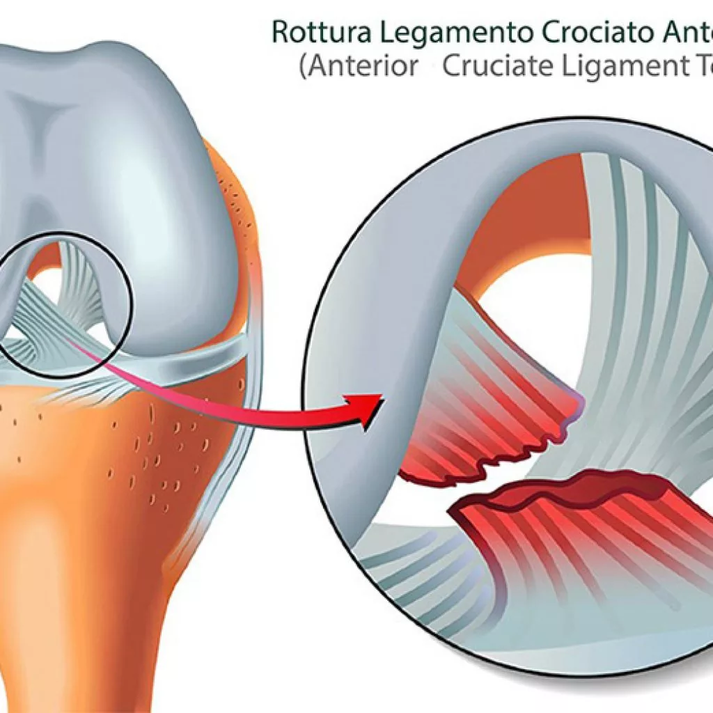 Illustrazione della rottura del legamento crociato anteriore del ginocchio con ingrandimento della lesione