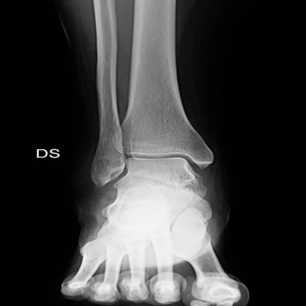 Radiografia del piede destro (DS) con vista frontale dell’articolazione della caviglia