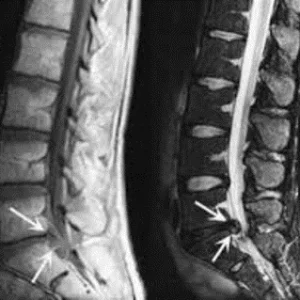 Immagine di risonanza magnetica della colonna lombare che mostra una possibile compressione radicolare da ernia del disco, indicata con frecce bianche