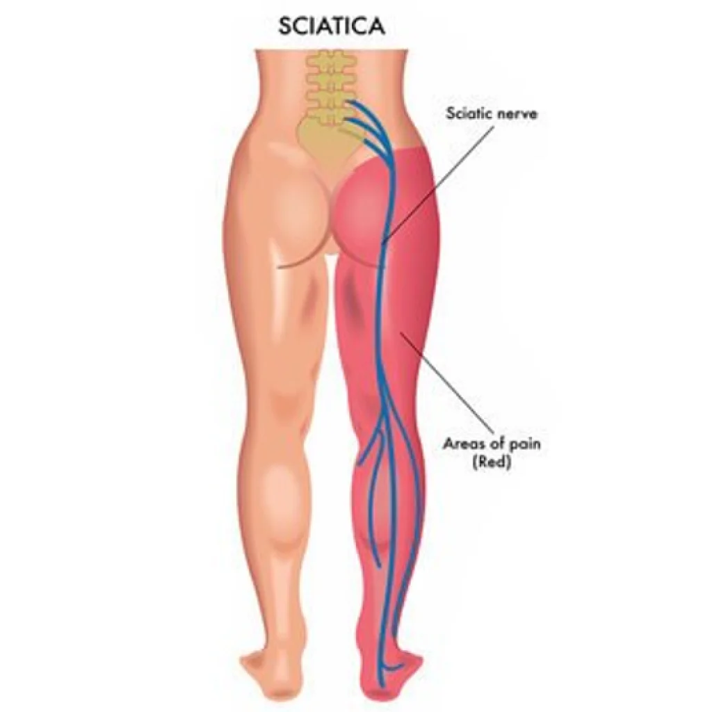 Illustrazione del percorso del nervo sciatico con evidenziazione delle zone dolorose lungo la gamba, tipiche della sciatalgia