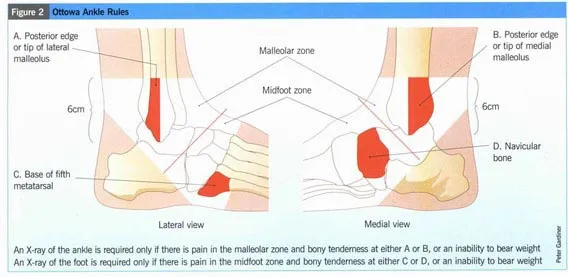 Schema delle Ottawa Ankle Rules con indicazioni delle zone anatomiche che richiedono radiografia in caso di dolore o incapacità a caricare peso