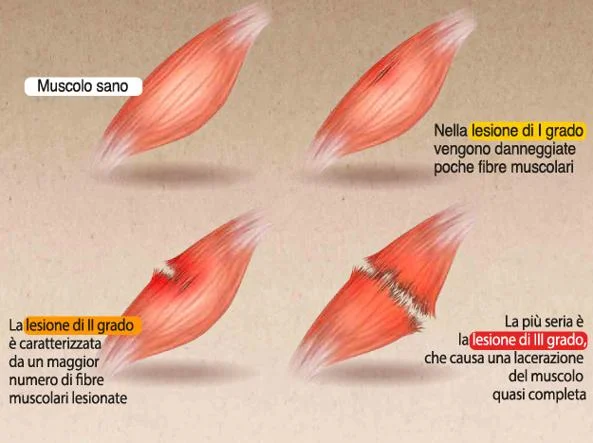 Confronto visivo tra muscolo sano e lesioni muscolari: primo grado (danno lieve a poche fibre), secondo grado (rottura parziale), terzo grado (lacerazione quasi completa del muscolo)