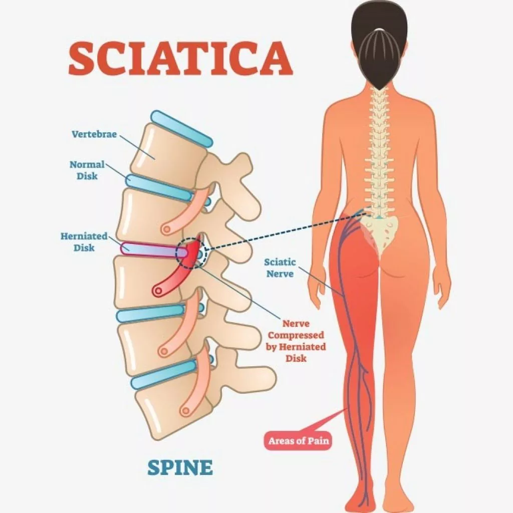Illustrazione della sciatica: ernia del disco lombare che comprime il nervo sciatico con sintomi dolorosi lungo gluteo, coscia e gamba