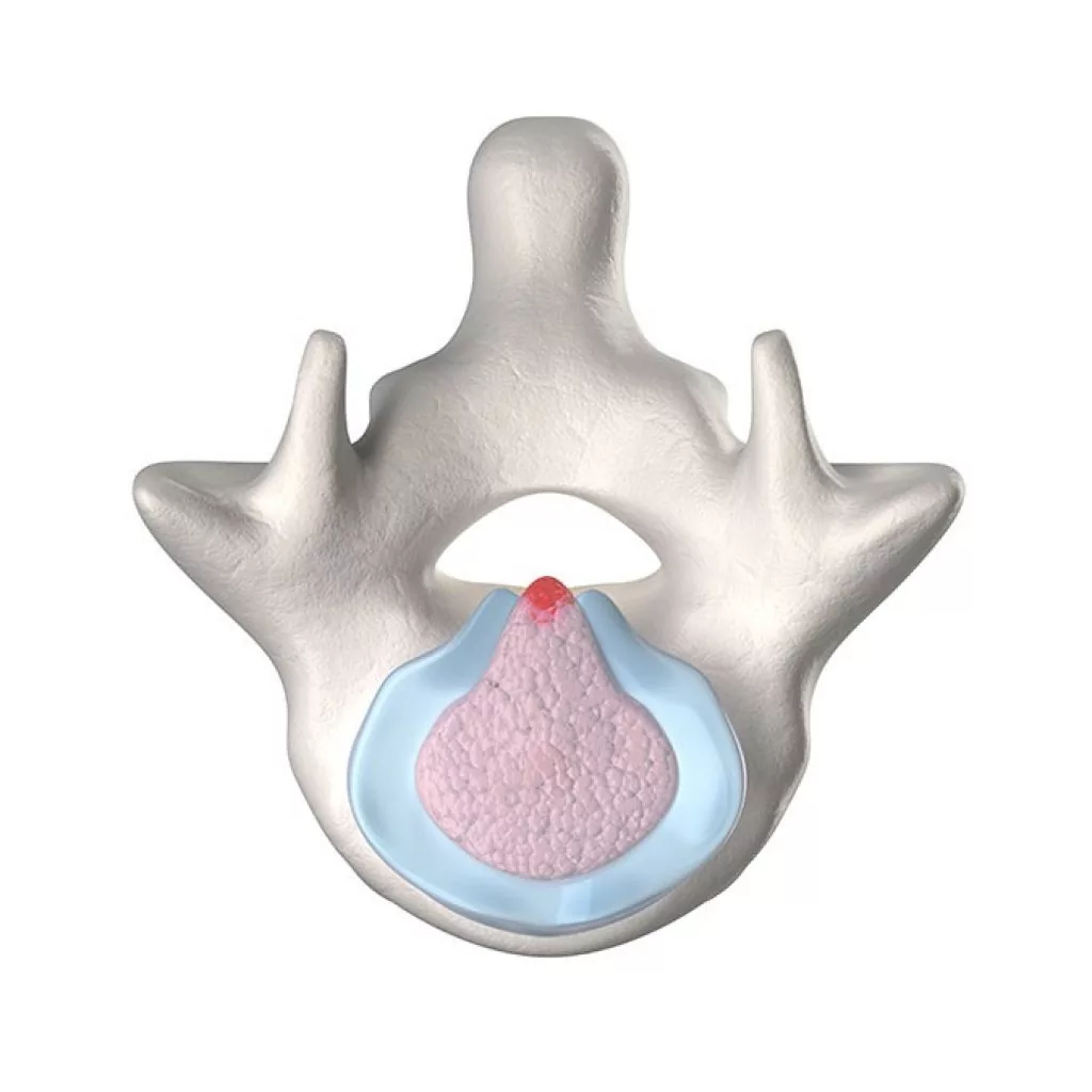 Raffigurazione di vertebra con ernia